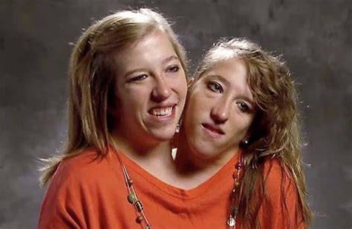 Conjoined twins abby and brittany hockeypole