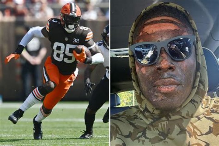 David Njoku seen with horror burns on his face after NFL star injured