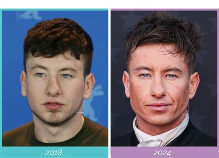 Has Barry Keoghan Done Facial Plastic Surgery? Net Worth Revealed 247