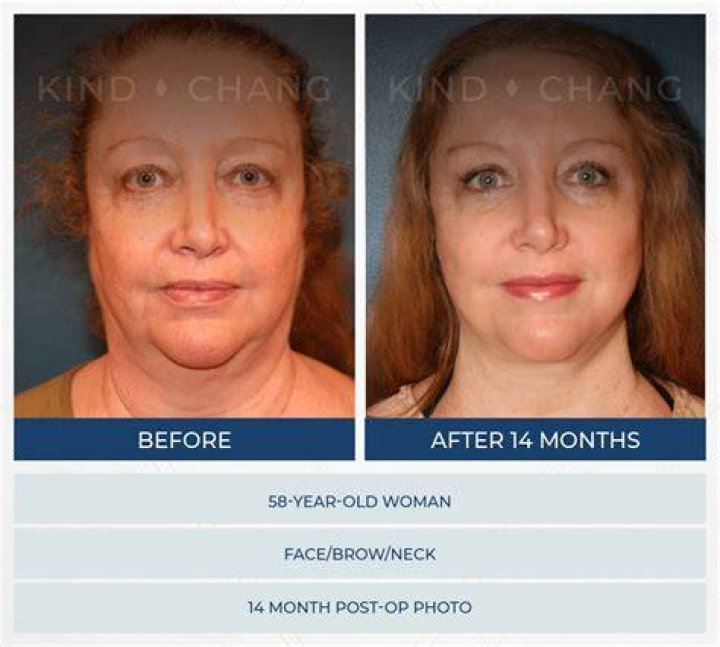 What Kind Of Plastic Surgery Did Simon Cowell Have? What Procedures Has